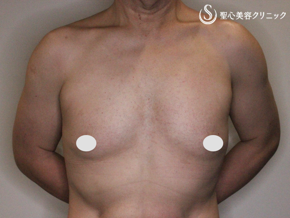 50代男性 Mtf 豊胸 ピュアグラフト豊胸術 2回 症例写真 美容整形 美容外科なら聖心美容クリニック