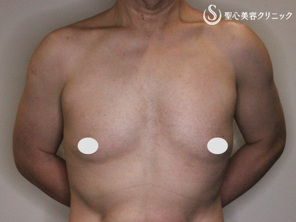 【50代男性・MTF 豊胸】ピュアグラフト豊胸術（2回） Before 