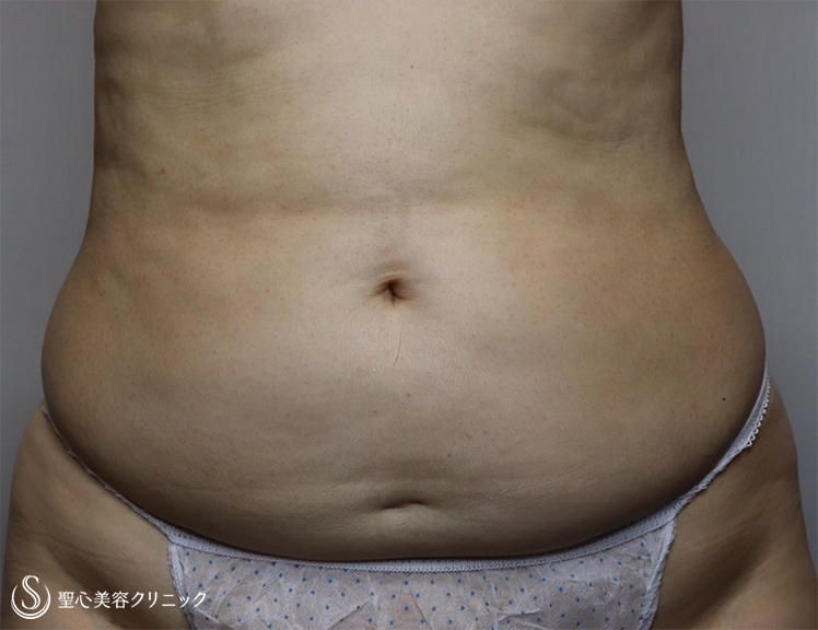 【60代女性・お腹周りと二の腕をスッキリ】ベイザー脂肪吸引（1ヶ月後） Before 