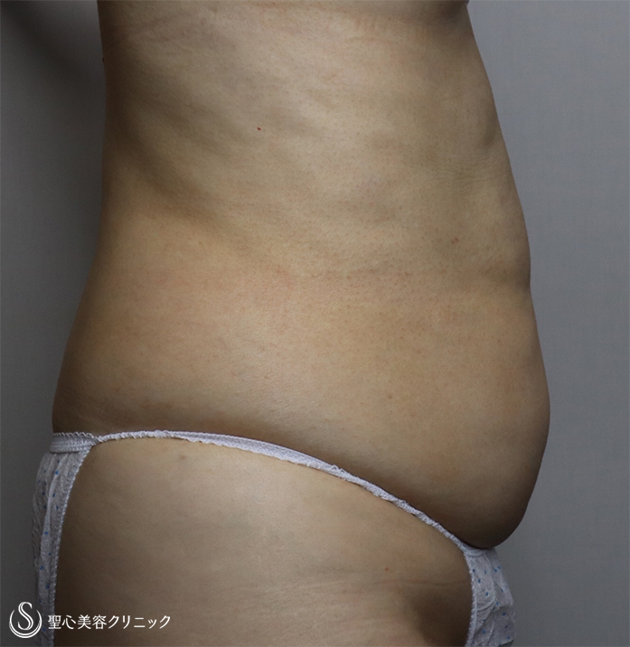【60代女性・お腹周りと二の腕をスッキリ】ベイザー脂肪吸引（1ヶ月後） Before 