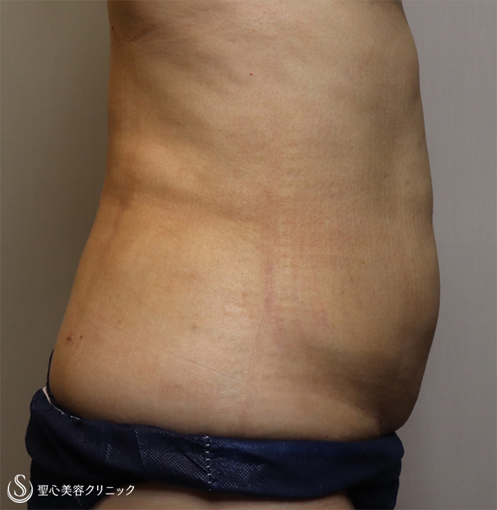 【60代女性・お腹周りと二の腕をスッキリ】ベイザー脂肪吸引（1ヶ月後） After 