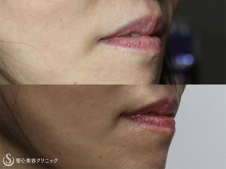 【50代女性・年齢と共に下がった口角をほぼ目立たず治療】プレミアム口角挙上術（1ヶ月後） After 