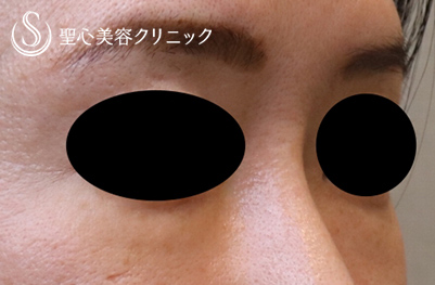 【40代女性・切らない目の下のクマ治療】プレミアムPRP皮膚再生療法 （施術後1ヶ月） After 