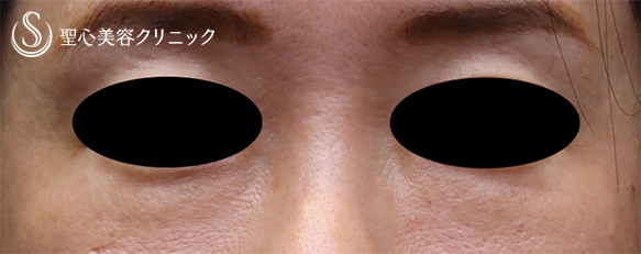 【40代女性・切らない目の下のクマ治療】プレミアムPRP皮膚再生療法 （施術後1ヶ月） After 