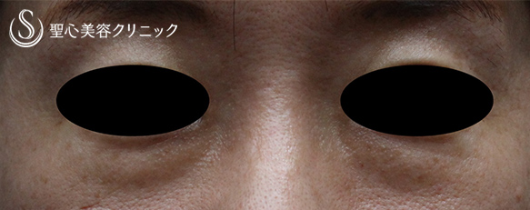 【40代女性・切らない目の下のクマ治療】プレミアムPRP皮膚再生療法 （施術後1ヶ月） Before 