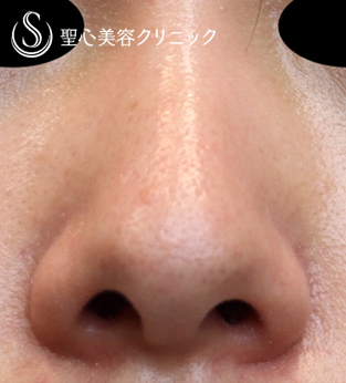 【20代女性・傷跡少なく小鼻を小さくする】小鼻縮小術（内側法）（術後１ヶ月） Before 