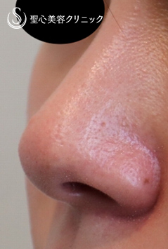 【20代女性・傷跡少なく小鼻を小さくする】小鼻縮小術（内側法）（術後１ヶ月） Before 