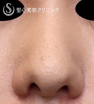 【20代女性・傷跡少なく小鼻を小さくする】小鼻縮小術（内側法）（術後１ヶ月） After 