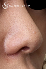 【20代女性・傷跡少なく小鼻を小さくする】小鼻縮小術（内側法）（術後１ヶ月） After 