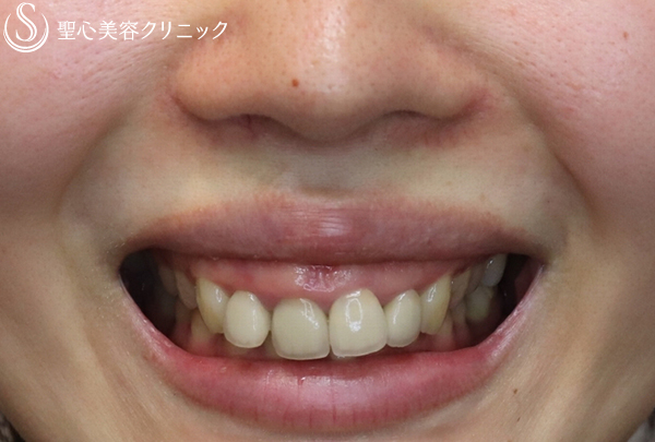 【20代女性 歯茎が見えないように！】ガミースマイル手術（１ヶ月後） Before 