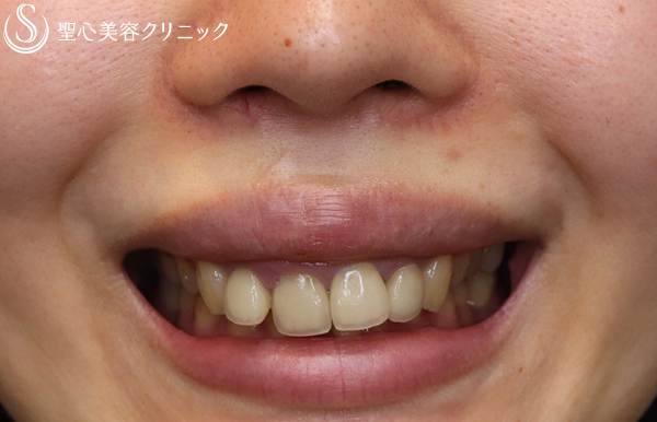 【20代女性 歯茎が見えないように！】ガミースマイル手術（１ヶ月後） After 