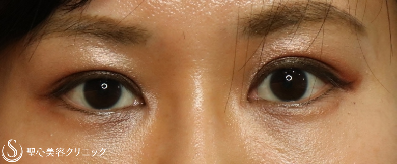【20代女性・まぶたの開きの左右差を修正】眼瞼下垂：腱膜縫縮法（施術直後＆2ヶ月後） Before 
