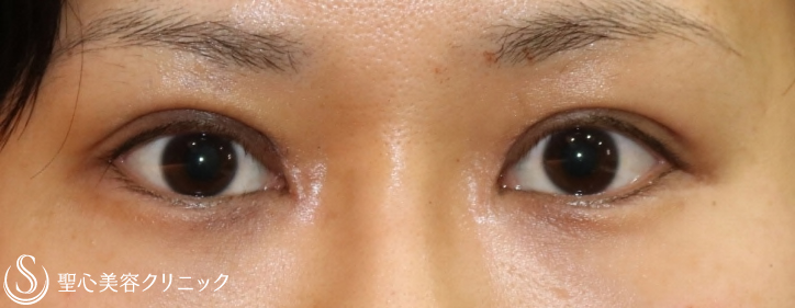 【20代女性・まぶたの開きの左右差を修正】眼瞼下垂：腱膜縫縮法（施術直後＆2ヶ月後） After 