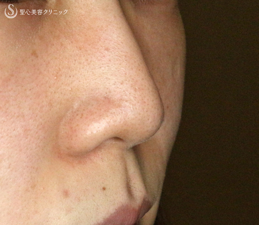 【20代女性・ダンゴ鼻】3D鼻尖用PCLドーム（1年8ヶ月後） Before 
