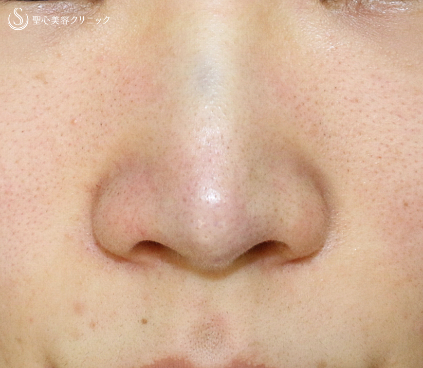 【20代女性・ダンゴ鼻】3D鼻尖用PCLドーム（1年8ヶ月後） Before 
