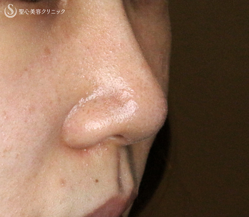 【20代女性・ダンゴ鼻】3D鼻尖用PCLドーム（1年8ヶ月後） After 