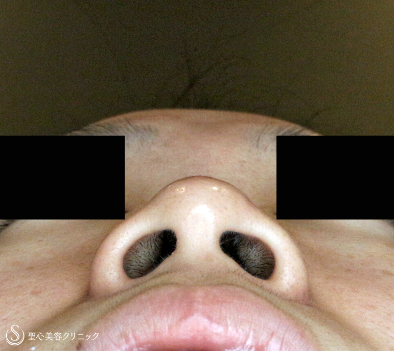 【20代女性・鼻の存在感を消す】小鼻縮小術+α法「Ver.3」（1年8ヶ月後） Before 