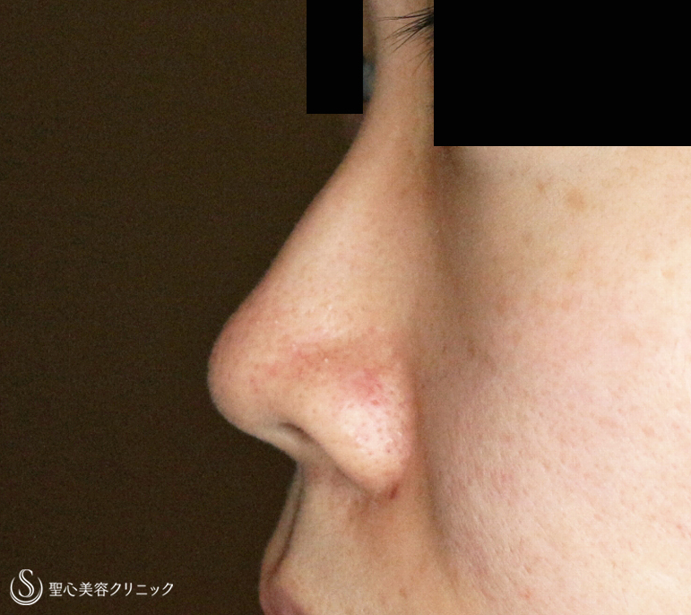 【20代女性・鼻の存在感を消す】小鼻縮小術+α法「Ver.3」（1年8ヶ月後） Before 