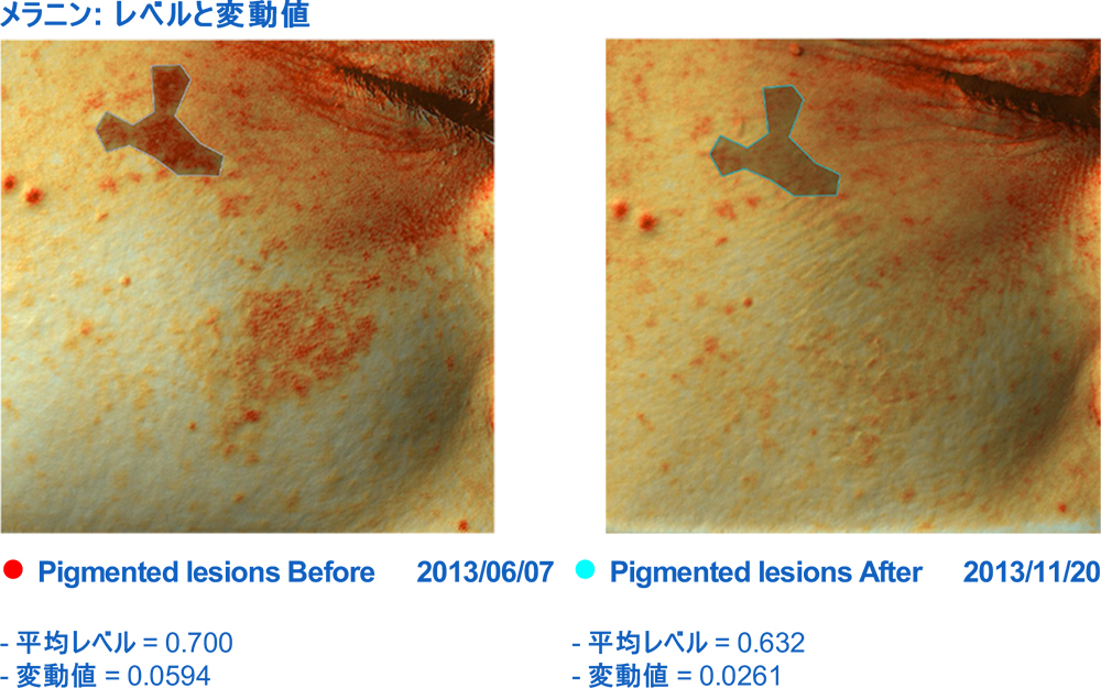 メラニンモード使用例（頬のシミ処置後Before・After）