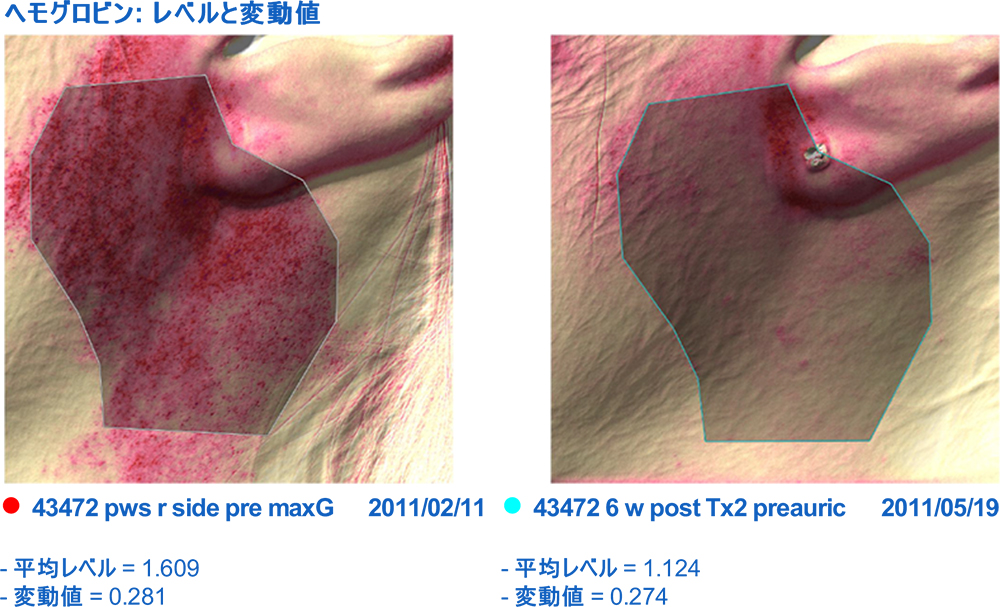 ヘモグロビンモード使用例（耳の下処置後Before・After）