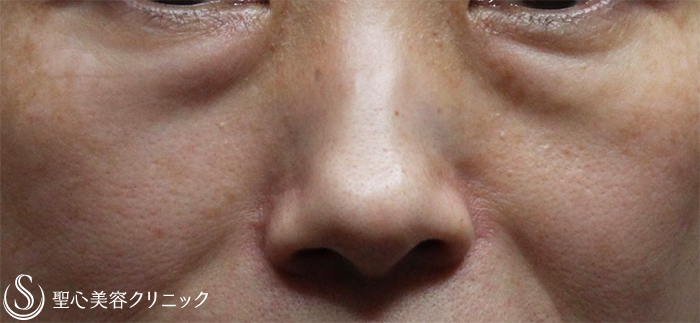 【50代女性・目元の若返り】プレミアムPRP皮膚再生療法（1ヶ月半後） Before 