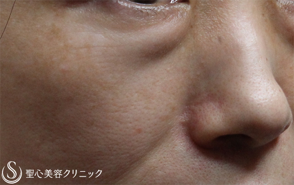 【50代女性・目元の若返り】プレミアムPRP皮膚再生療法（1ヶ月半後） Before 
