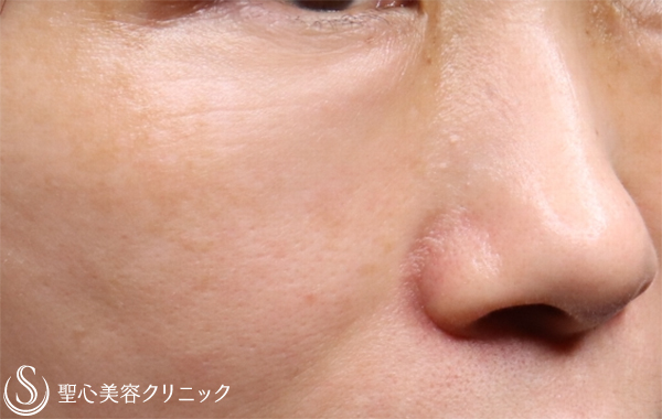 【50代女性・目元の若返り】プレミアムPRP皮膚再生療法（1ヶ月半後） After 