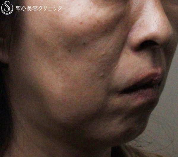 【40代女性・頬とフェイスラインのタルミを引き上げたい】アンカーMAX +顎のヒアルロン酸注入（1ヶ月後） Before 