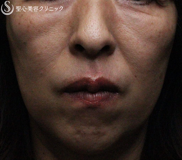 【40代女性・頬とフェイスラインのタルミを引き上げたい】アンカーMAX +顎のヒアルロン酸注入（1ヶ月後） After 
