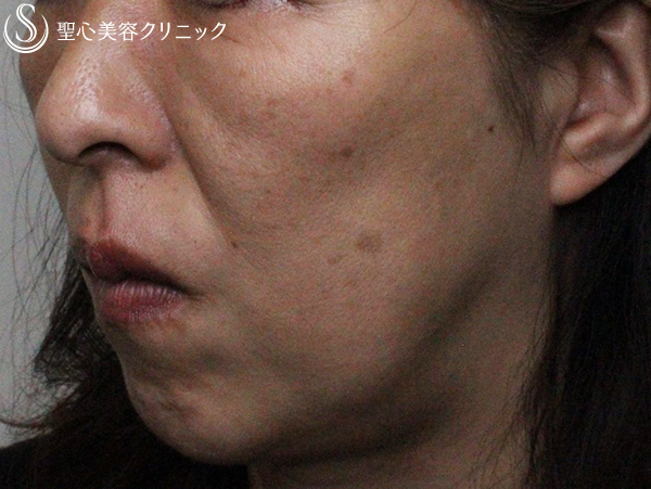 【40代女性・頬とフェイスラインのタルミを引き上げたい】アンカーMAX +顎のヒアルロン酸注入（1ヶ月後） After 