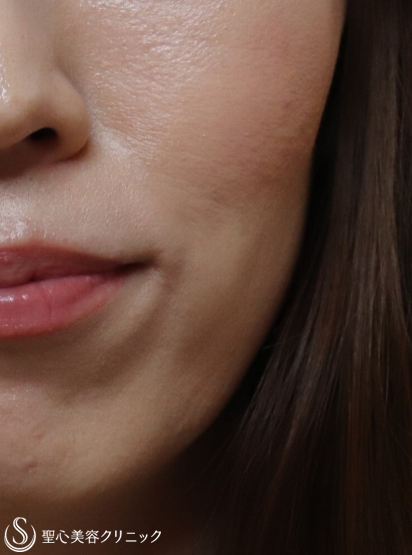【40代女性・頬のくぼみを改善】プレミアムPRP皮膚再生療法 Before 