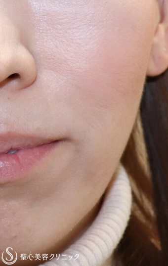 【40代女性・頬のくぼみを改善】プレミアムPRP皮膚再生療法 After 