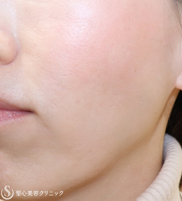 【40代女性・頬のくぼみを改善】プレミアムPRP皮膚再生療法 After 