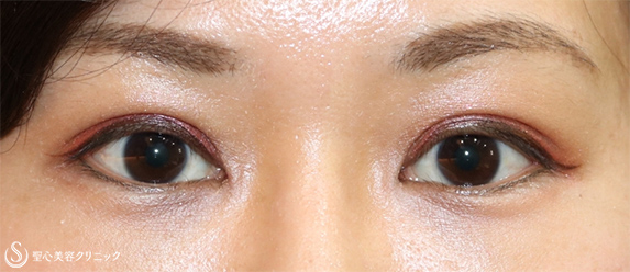【20代女性・まぶたの開きの左右差を修正】眼瞼下垂：腱膜縫縮法（施術直後＆2ヶ月後） After 