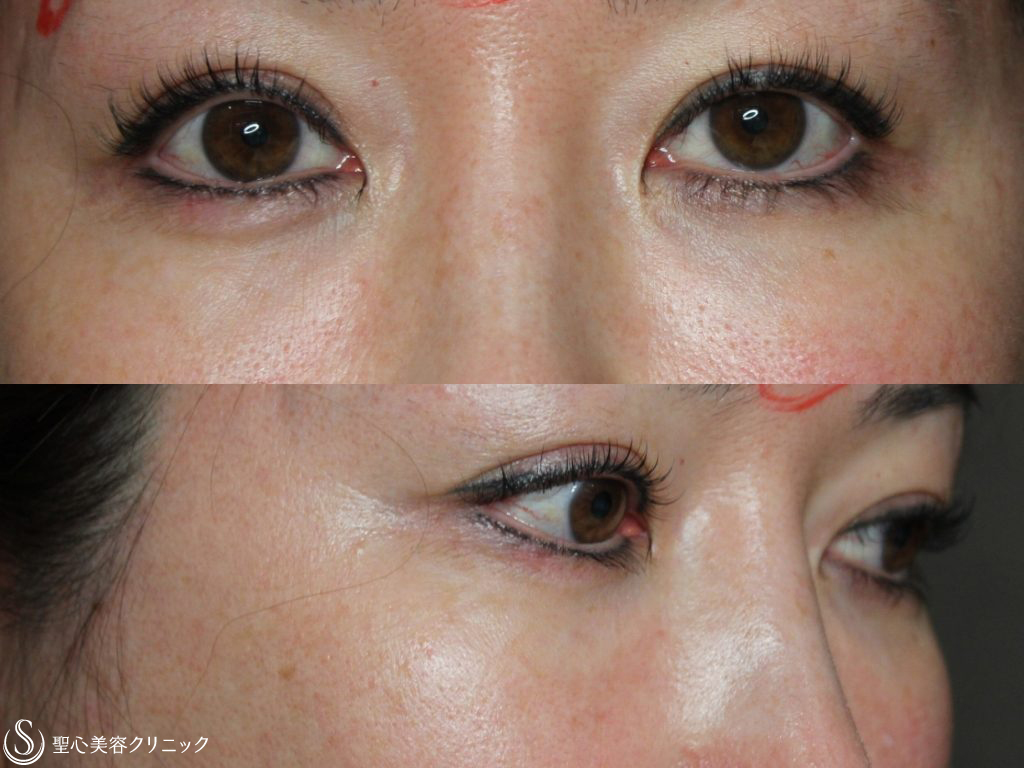 【40代女性・目の下のクマと凹みたるみの改善】プレミアムPRP皮膚再生療法（半年後） After 