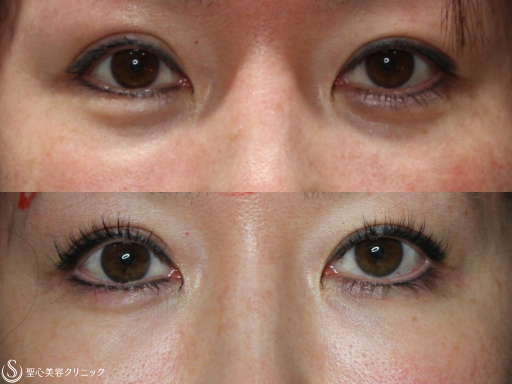 【40代女性・目の下のクマと凹みたるみの改善】プレミアムPRP皮膚再生療法（半年後） After 