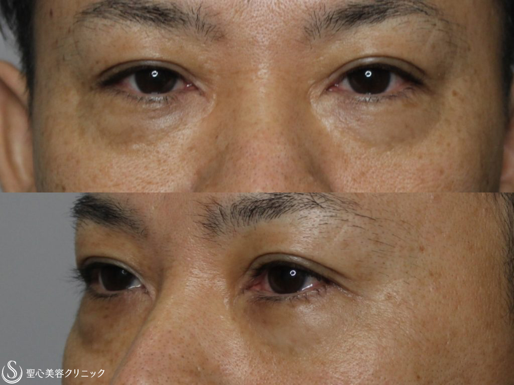 【40代男性・10歳目元が若返る】目の下の脂肪除去+プレミアムPRP皮膚再生療法（8ヶ月後） Before 