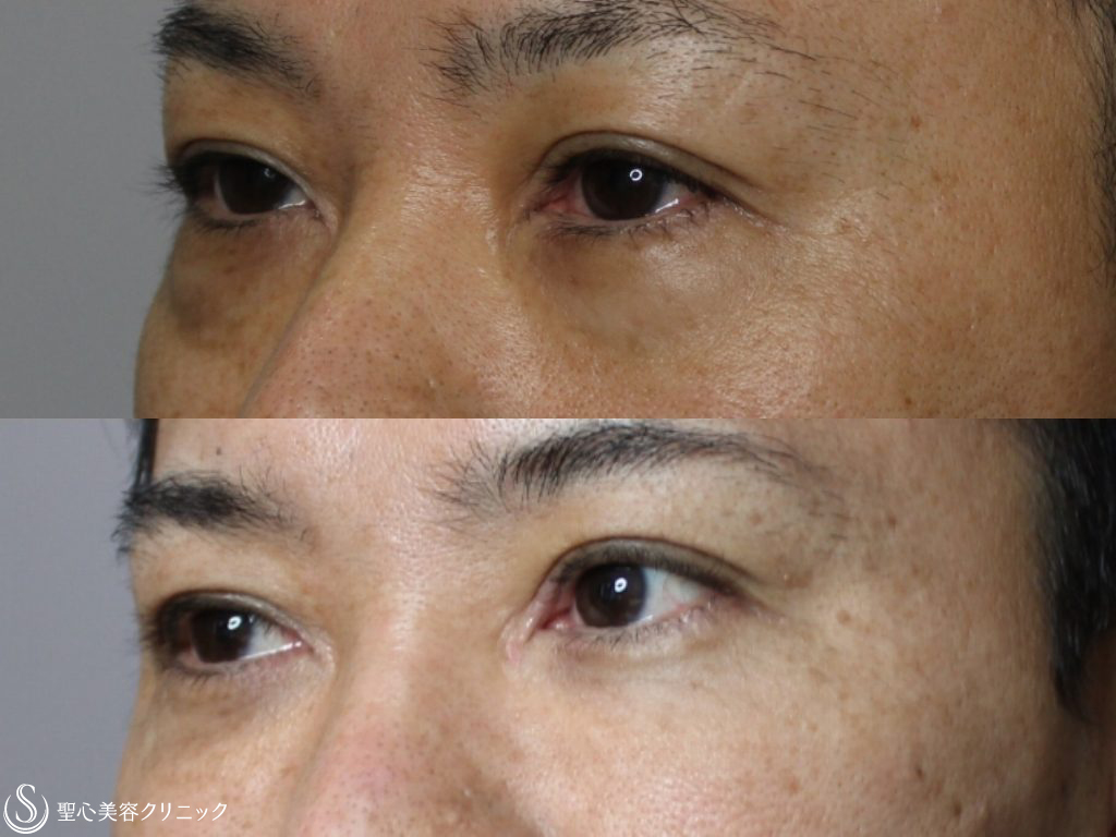 【40代男性・10歳目元が若返る】目の下の脂肪除去+プレミアムPRP皮膚再生療法（8ヶ月後） After 