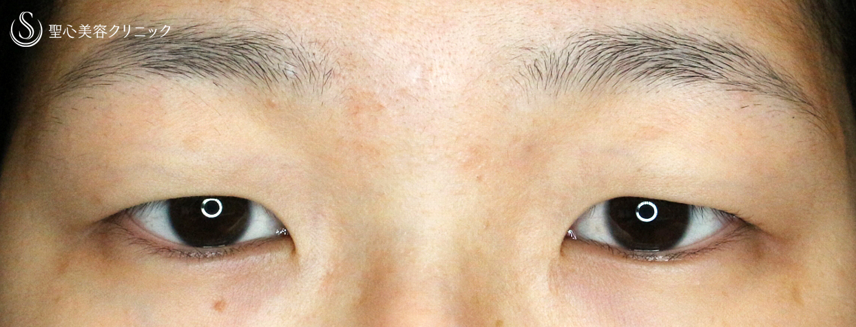 代女性 厚いまぶた 二重全切開 A法 Ver 4 1ヶ月後 症例写真 美容整形 美容外科なら聖心美容クリニック