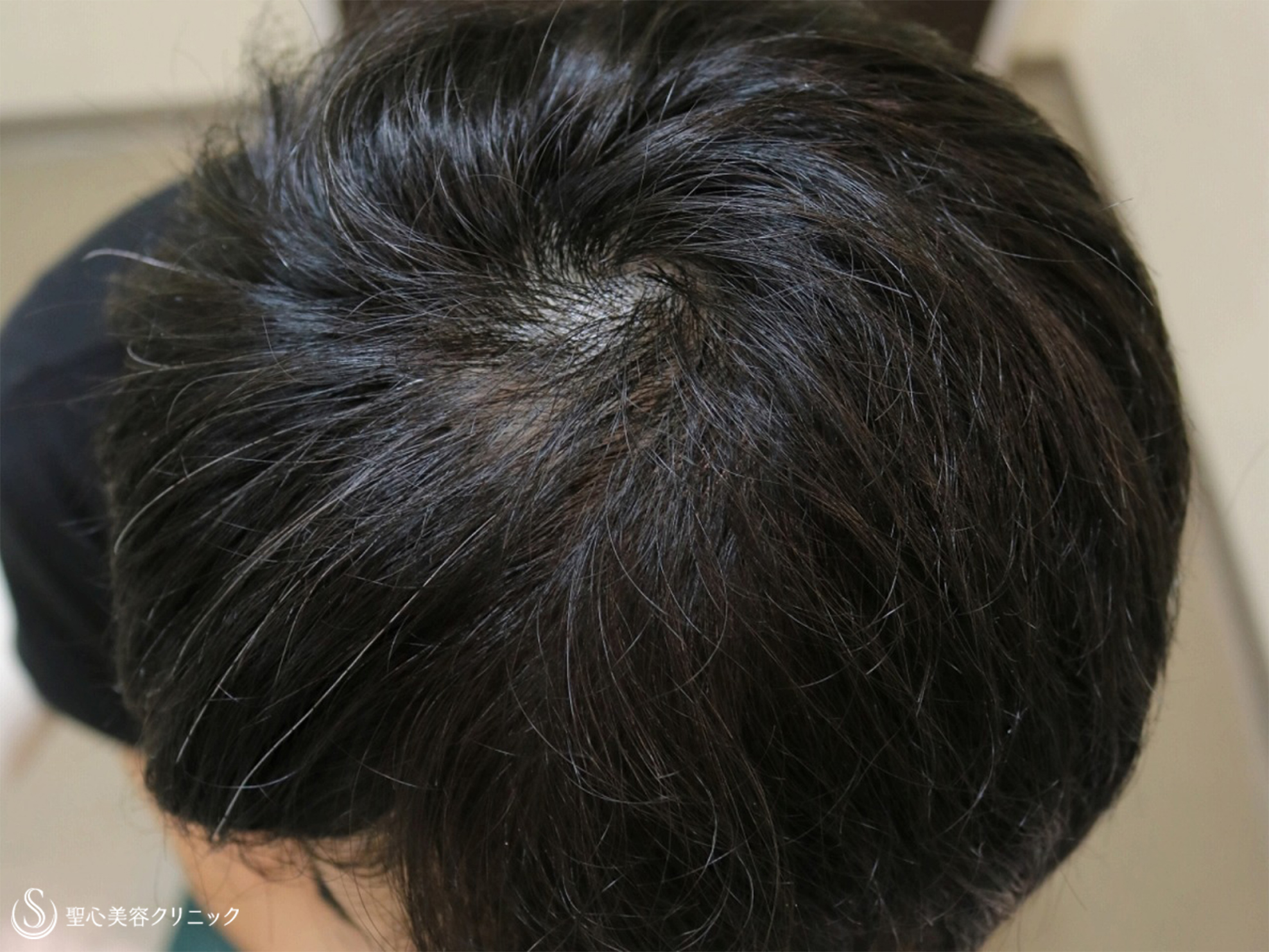 【30代男性・毛を太くハリのある良い髪に】グロースファクター毛髪再生療法（6回）+フィナステリド錠内服（8ヶ月後） Before 