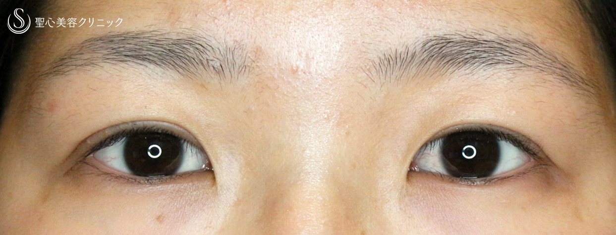 代女性 厚いまぶた 二重全切開 A法 Ver 4 1ヶ月後 症例写真 美容整形 美容外科なら聖心美容クリニック 代女性 厚いまぶた 二重全切開 A法 Ver 4 1ヶ月後 症例写真 美容整形 美容外科なら聖心美容クリニック