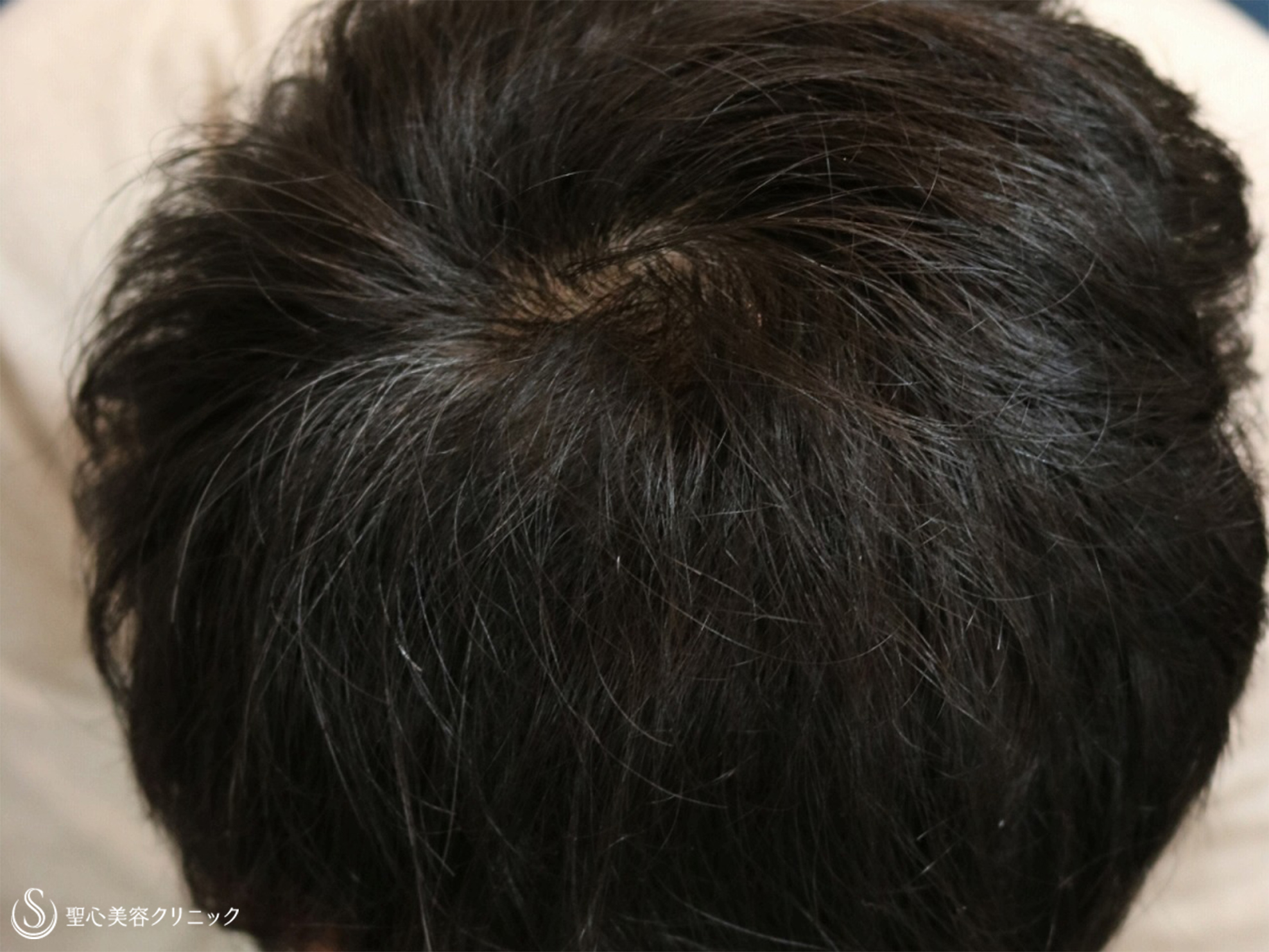【30代男性・毛を太くハリのある良い髪に】グロースファクター毛髪再生療法（6回）+フィナステリド錠内服（8ヶ月後） After 