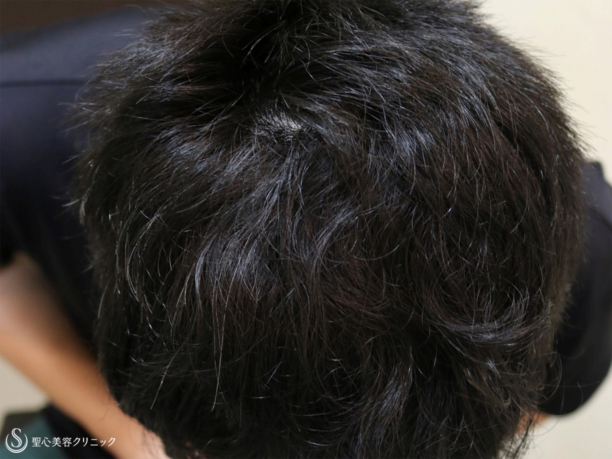 【30代男性・毛を太くハリのある良い髪に】グロースファクター毛髪再生療法（6回）+フィナステリド錠内服（8ヶ月後） After 