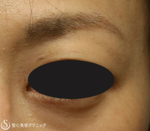 【40代女性・目の上のくぼみ】プレミアムPRP皮膚再生療法（8年後） After 