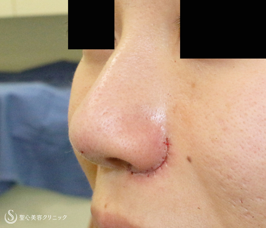 【20代女性・忘れ鼻＝存在感を消す】小鼻縮小術+α法 「Ver.4」＆ Gメッシュ（1年後） Before 