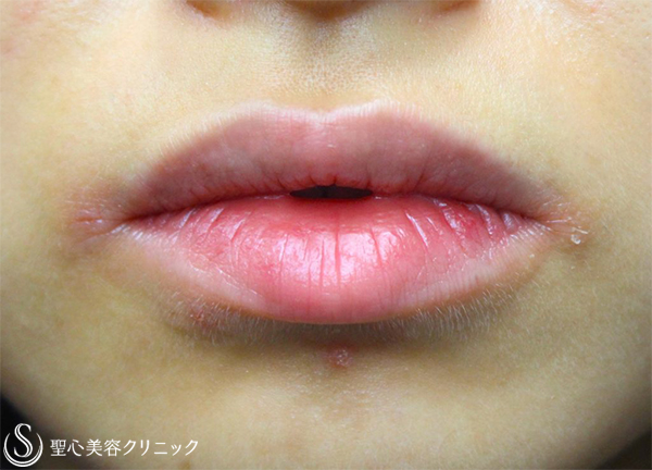 【20代女性・かわいい唇】スマイルリップ（4ヶ月後） Before 