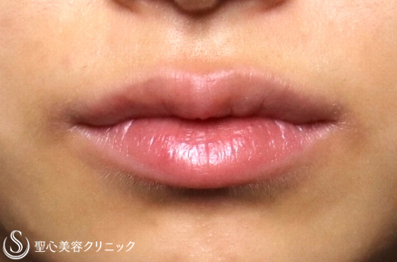 【20代女性・かわいい唇】スマイルリップ（4ヶ月後） After 