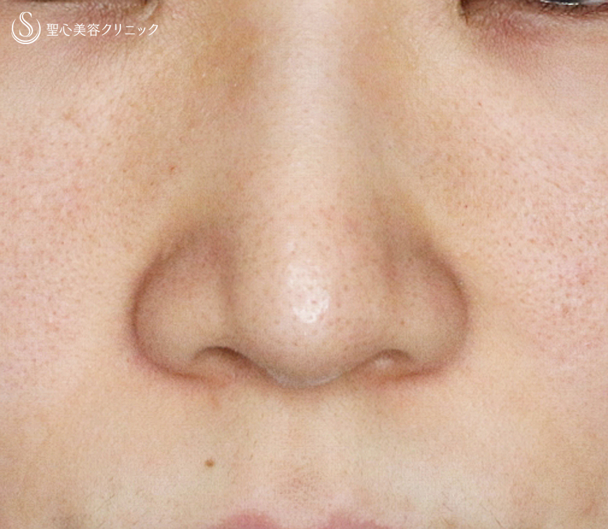 【20代女性・ダンゴ鼻】3D鼻尖用PCLドーム（1年8ヶ月後） After 