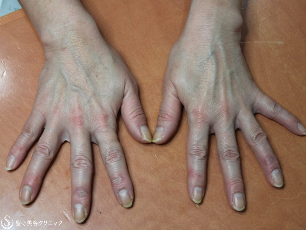【50代女性・手の甲を10歳若く！！】プレミアムPRP皮膚再生療法（4年後） Before 