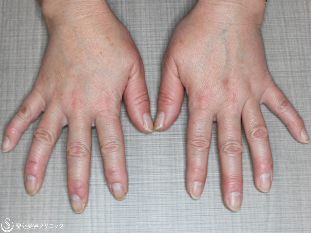 【50代女性・手の甲を10歳若く！！】プレミアムPRP皮膚再生療法（4年後） After 